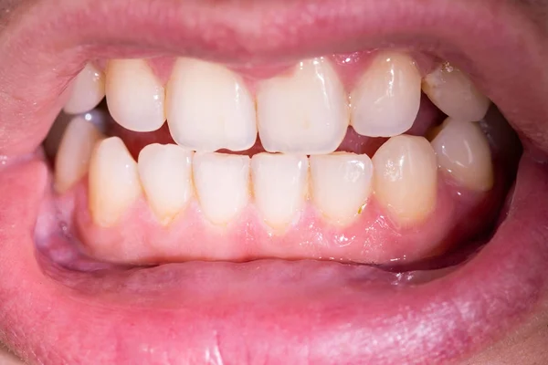 Надпись Зубах Взрослого Крупным Планом Укус Челюсти Надлежащая Стоматологическая Помощь — стоковое фото