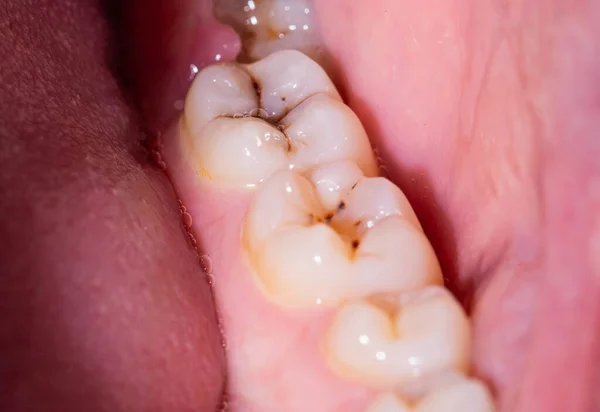 Carie Bocca Sui Denti Masticare Installazione Otturazioni Dentali Alta Qualità — Foto Stock