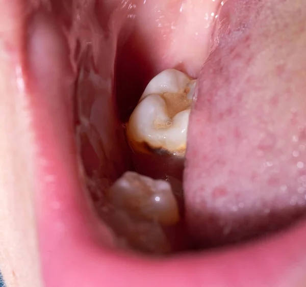 把咀嚼的牙齿从嘴里拔掉后的洞 宏科拔牙后牙龈的治疗 — 图库照片