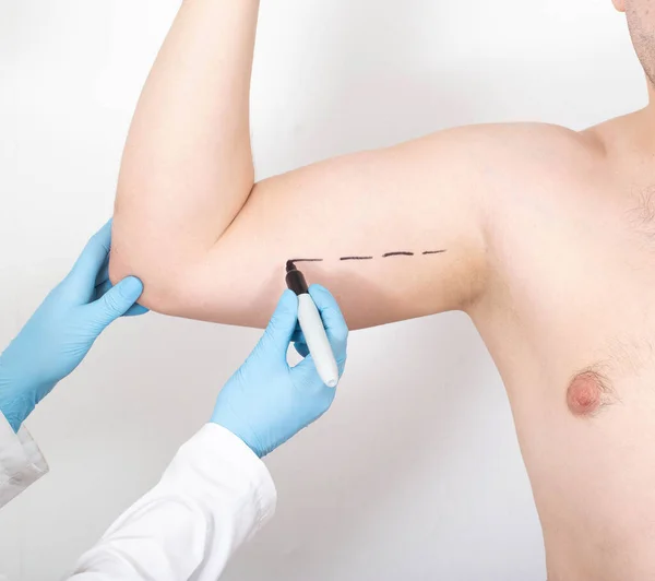 Médico Marca Lugar Brazo Con Marcador Para Operación Para Aumentar —  Fotos de Stock