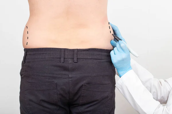 성형외과 의사는 환자의 허벅지에 문제가 부위에 마커를 표시를 성형수술을 — 스톡 사진