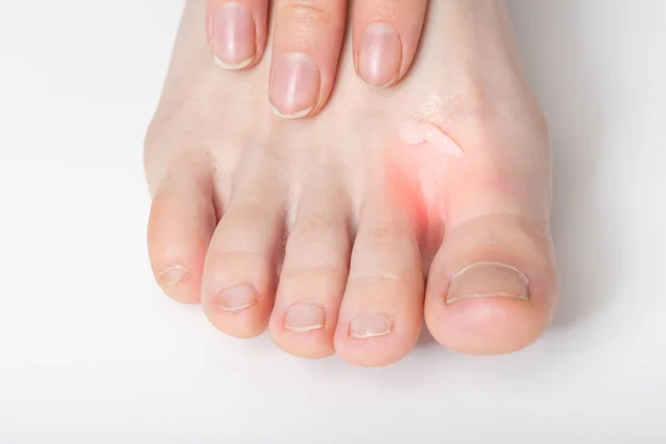 Girl Applies Healing Ointment Toes Fungus Sweating Feet Close — Stock Photo, Image