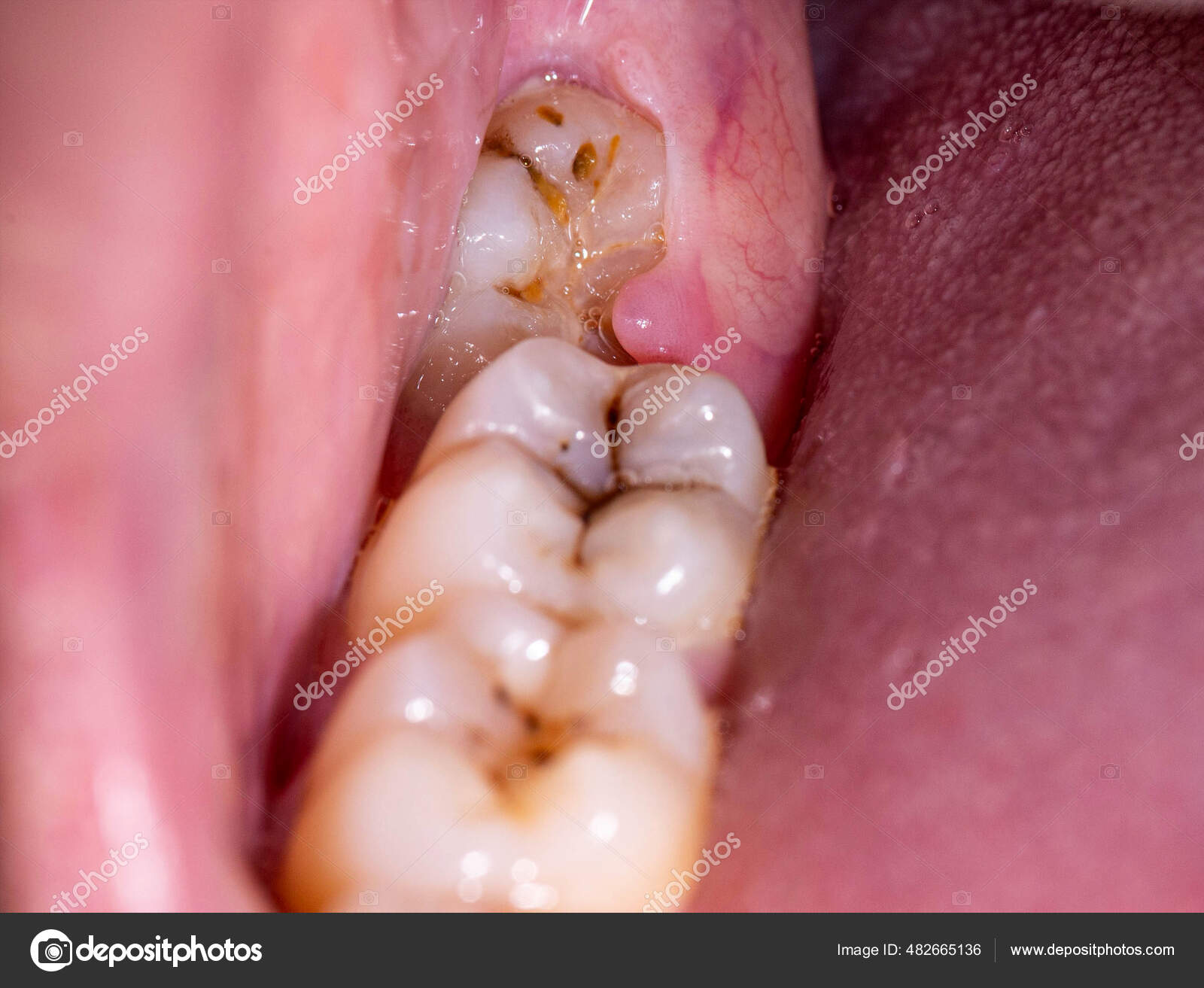 牙齒咬起來酸酸的---牙齒裂了 - 案例介紹 - 美容牙科張凱榮醫師