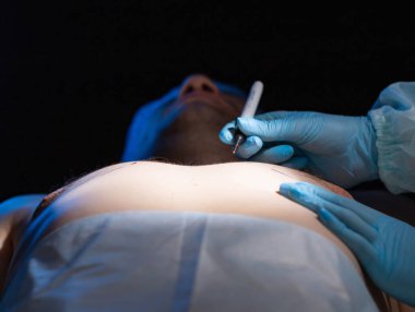 Doktor plastik cerrah, erkek göğsünü düzeltmek için keçeli kalemle işaretler yapıyor..