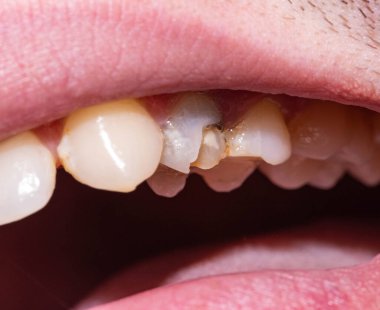 İçinde diş minesinin koparıldığı siyah bir diş, bir diş kırığı. Modern dişçilikte dişçilik konsepti, makro. Ortodontik