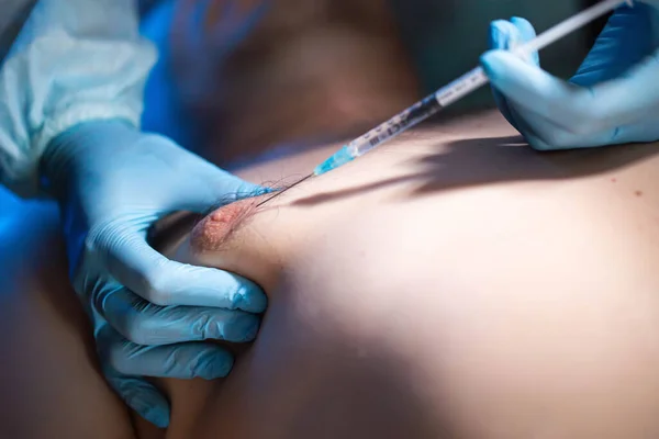 Doctor plastic surgeon with a syringe to correct the adipose tissue of the male breast. Reduction of male breast from fat, gynecomastia, lipofilling