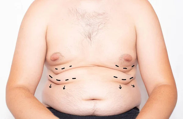Vücudunda Yağ Kıvrımları Olan Şişman Bir Adam Yağ Aldırma Plastik — Stok fotoğraf