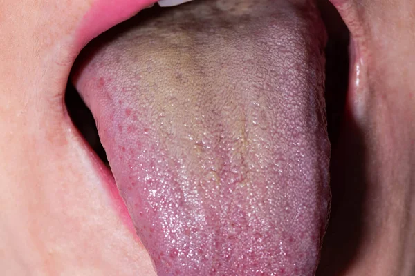 少女の舌の上に黄色のコーティングのクローズアップ 消化管の病気の兆候 肝臓と胆嚢疾患 — ストック写真