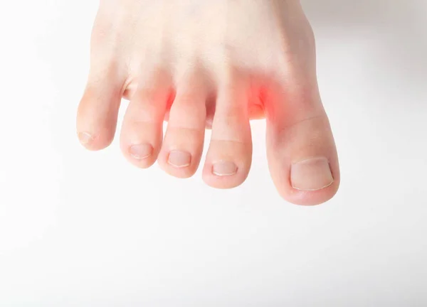 Сухая Кожа Раздражение Между Пальцами Ног Белый Фон Концепция Лечения — стоковое фото
