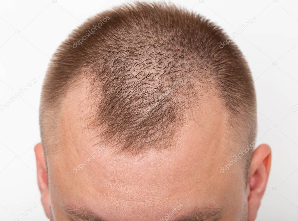 Bald patches on the head of a young man. The concept of the increased hormone dihydrotestosterone. Weakening of hair follicles, healthcare