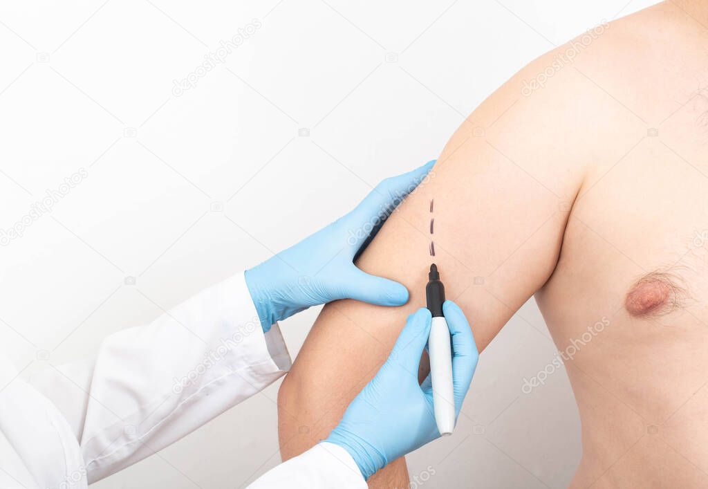 The doctor marks the place on the arm with a marker for the operation to increase the triceps and biceps using an implant. Copy space for text, triangularis