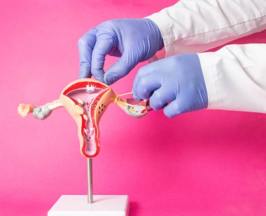 Doktor jinekolog, dölyatağı borularını kadın üreme sisteminin dizilişine bağlıyor, pembe arka plan. İstenmeyen hamileliğe karşı doğum kontrol konsepti, jinekolojide ameliyat