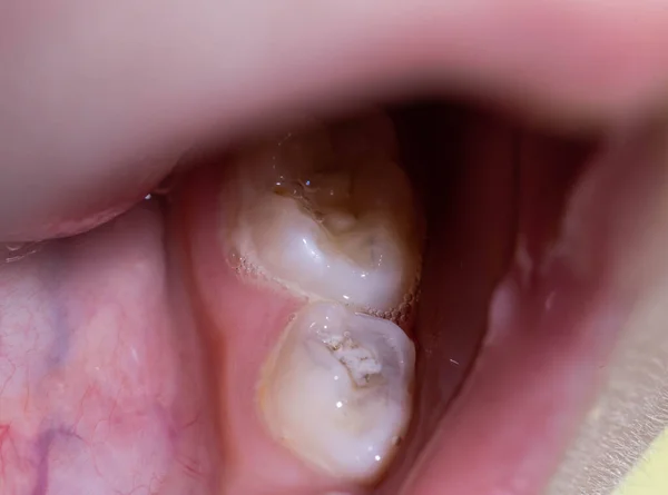 Καρύδια Στο Δόντι Ενός Μωρού Κοντινό Πλάνο Έννοια Της Οδοντιατρικής — Φωτογραφία Αρχείου