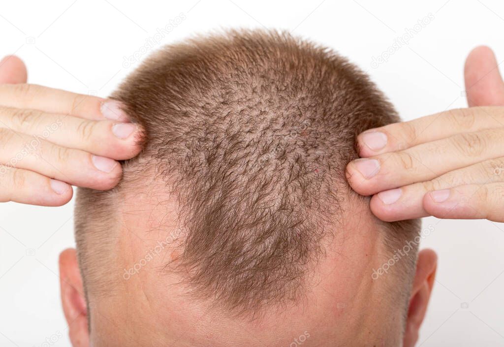 Bald patches on the head of a young man. The concept of the increased hormone dihydrotestosterone. Weakening of hair follicles, healthcare