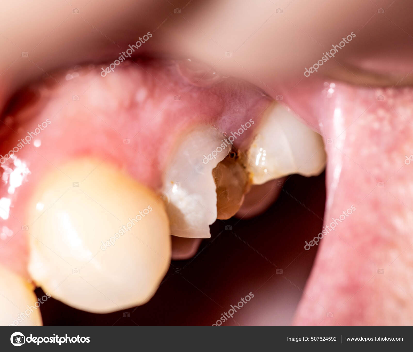 别让缺失的一颗牙，毁了你的整口好牙！_深圳爱康健口腔医院官网