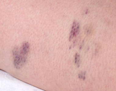 Bir kadının bacaklarında çürükler ve tromboz. Phlebeurysm, yakın plan