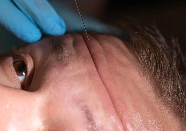 Doctor cosmetologist makes injections into the forehead against mimic wrinkles. Smoothing facial wrinkles in men