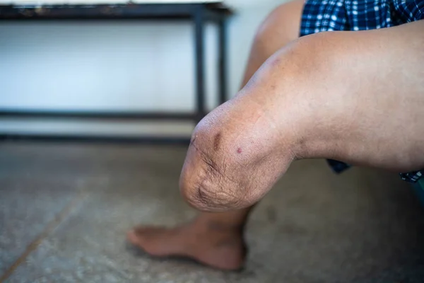 Abaixo Coto Amputação Joelho Treinamento Muscular Para Prótese — Fotografia de Stock