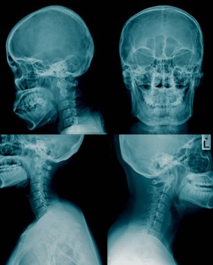 mavi tonda kafatası x-ray görüntüsü koleksiyonu