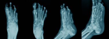 toplanan ayak kırığı x-ray görüntüsü mavi tonda