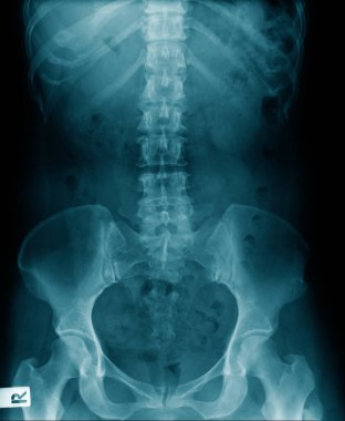 X-ray torako-bel insan yapısı leğen kemiği mavi tonda. 