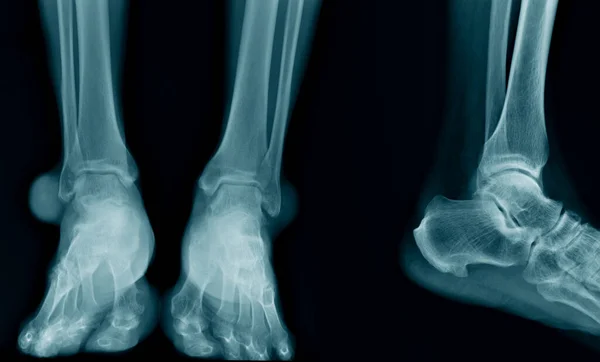 Рентгенівське Зображення Щиколотки Синьому Тоні Чорному Фоні — стокове фото