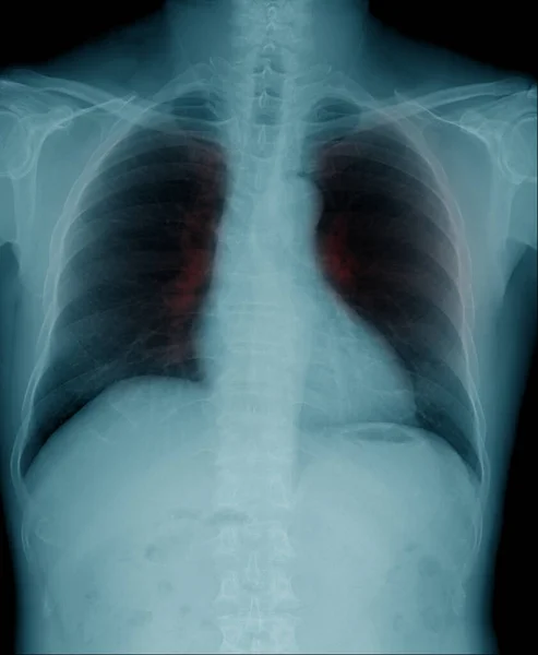 Mellkasröntgen Kép Kék Tónusban Tüdő Váladékozással Tüdőben — Stock Fotó