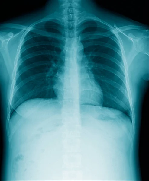 Nagy Qaulity Mellkas Röntgen Kép Kék Tónusú Fekete Háttér Tüdő — Stock Fotó
