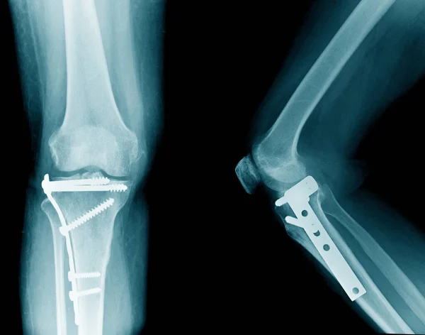膝关节 胫骨骨折及术后内固定的X线图像 — 图库照片