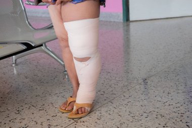Filariazis hastası, anormal lenfatik fonksiyon hastası.
