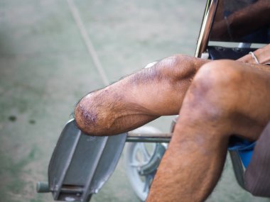 protez bacak aygıtı için stent eğitimi