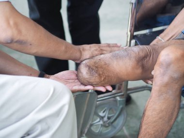 protez bacak aygıtı için stent eğitimi