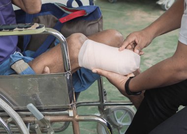 Elastik bandajlı protez için diz ampütasyonu