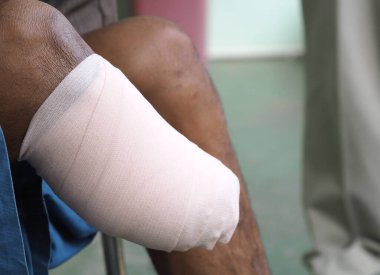Diz ampütasyonunun altında elastik bandaj var