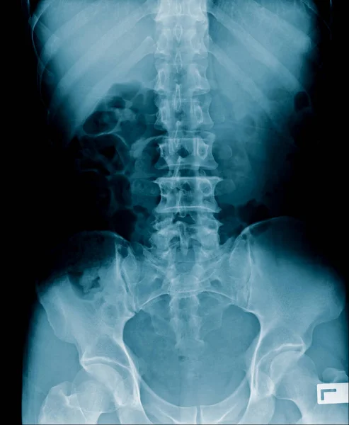 人間の腹部のX線画像 ヒトの脊椎と骨盤の骨の画像は 脊椎の変性変化を示しています 腰痛や下肢への痛みを参照してください — ストック写真