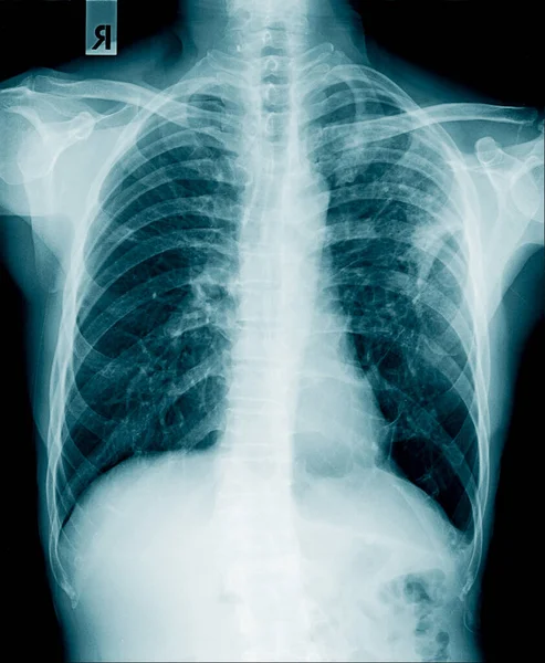 x-ray image of human abdomen, picture of human spine and pelvic bone show degenerative change of spine, low back pain and refer pain to lower limb