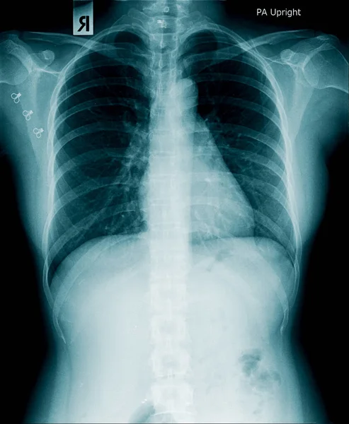 x-ray image of human abdomen, picture of human spine and pelvic bone show degenerative change of spine, low back pain and refer pain to lower limb