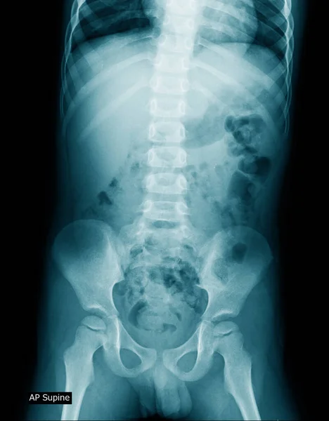 Παιδί Ακτινογραφία Εικόνα Της Ανθρώπινης Κοιλιάς — Φωτογραφία Αρχείου