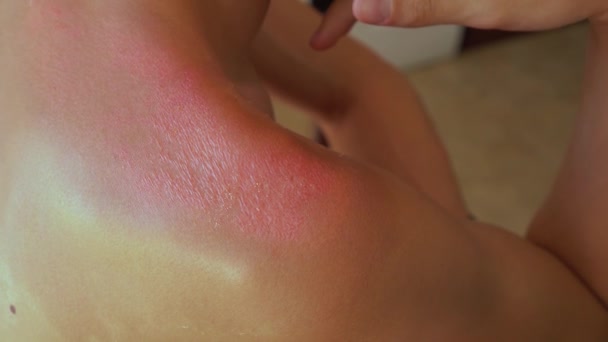 Sunburn of the skin. Sunburn on the severely sunburned skin. Pain, redness and swollen — Stock Video