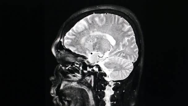 MRI mózgu skanowania na czarnym tle — Wideo stockowe