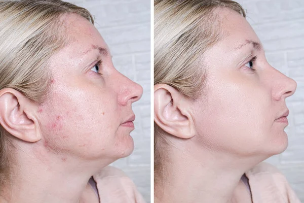 Giovane Donna Prima Dopo Trattamento Acne Cura Della Pelle Concetto — Foto Stock