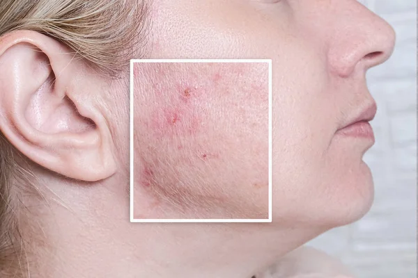 Junge Frau Vor Und Nach Akne Behandlung Hautpflege Und Dermatologischem — Stockfoto