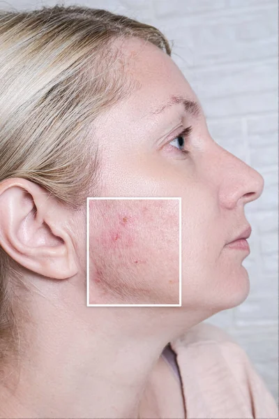 Giovane Donna Prima Dopo Trattamento Acne Skincare Dermatologia Concetto Imperfezioni — Foto Stock