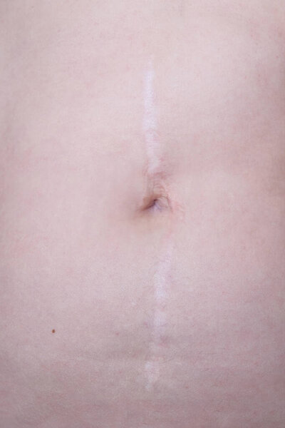 Шрам от кесарева сечения через три года после операции.