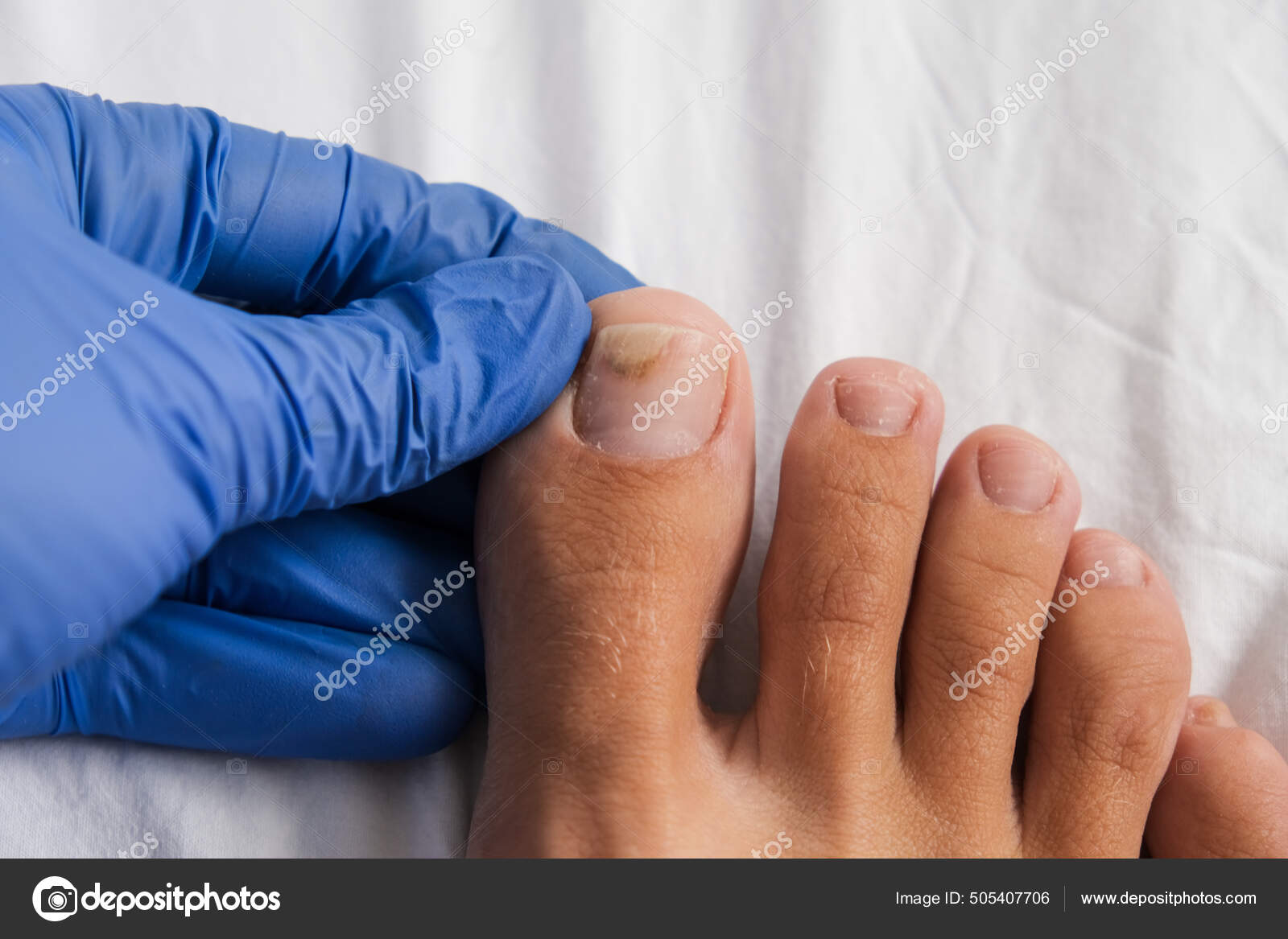 A doctor examines bare foot with onycholysis on a toenail after