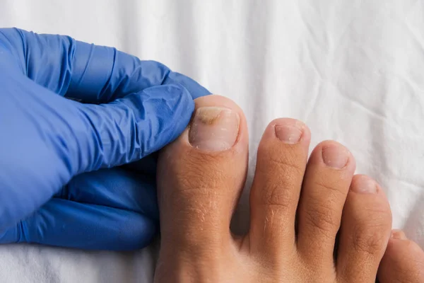 Ein Arzt untersucht den nackten Fuß mit Onycholyse am Zehennagel, nachdem er ihn mit engen Schuhen oder Gellack beschädigt hat — Stockfoto