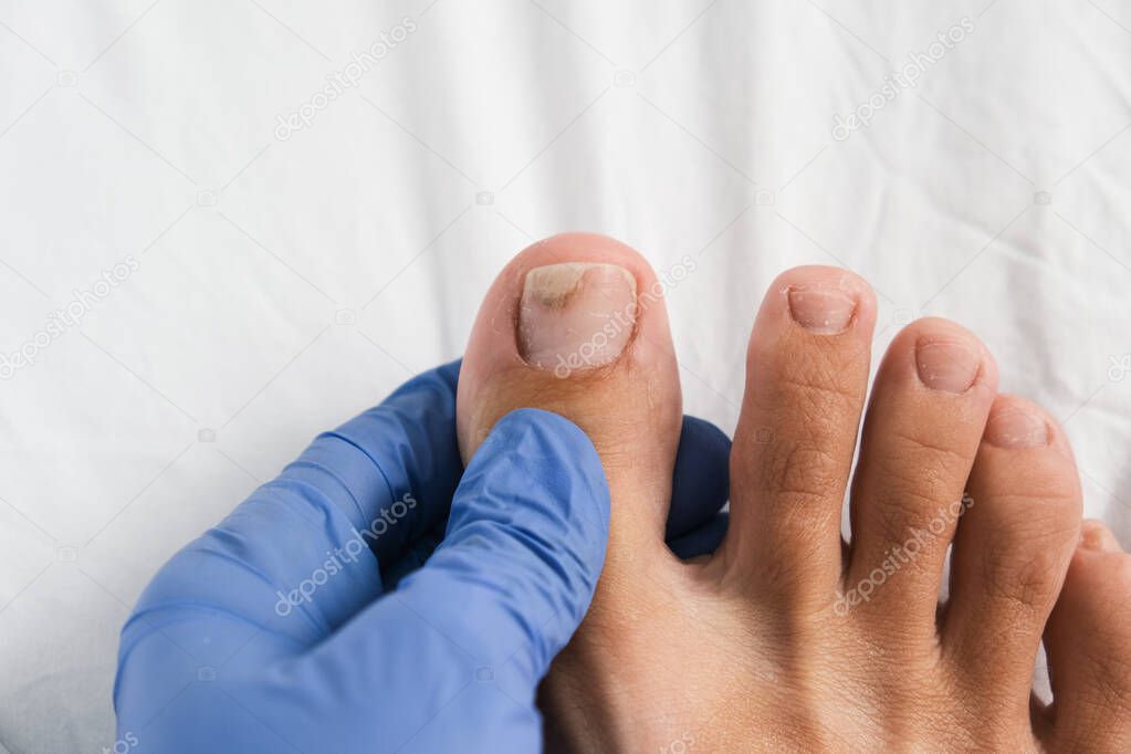 A podologist examines bare foot with onycholysis on a toenail after damaging with tight shoes or using gel-lacquer