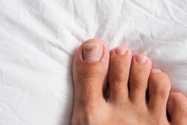 Bare fot med onykolys på en tånagel efter skador med trånga skor — Stockfoto