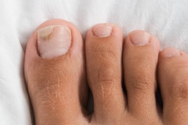 Bare foot with onycholysis on a toenail after damaging with tight shoes or using gel-lacquer. clipart