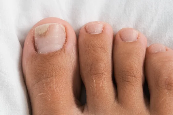 Nackter Fuß Mit Onycholyse Zehennagel Nach Beschädigung Mit Engen Schuhen — Stockfoto